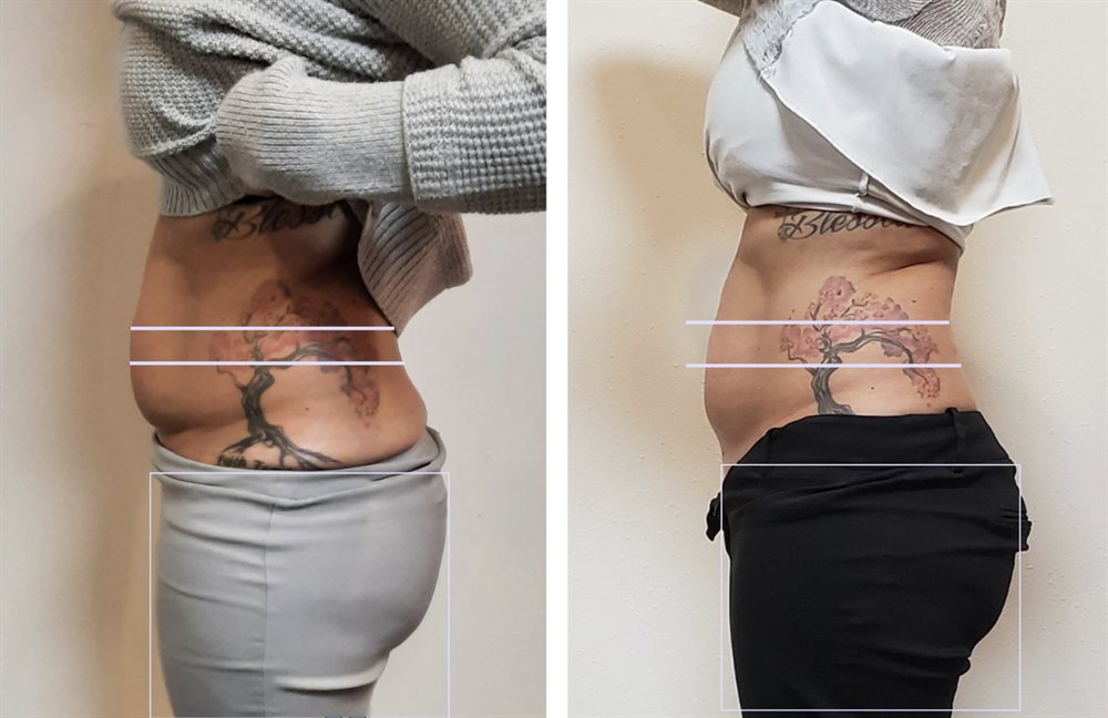 Abdomen contouring before and after