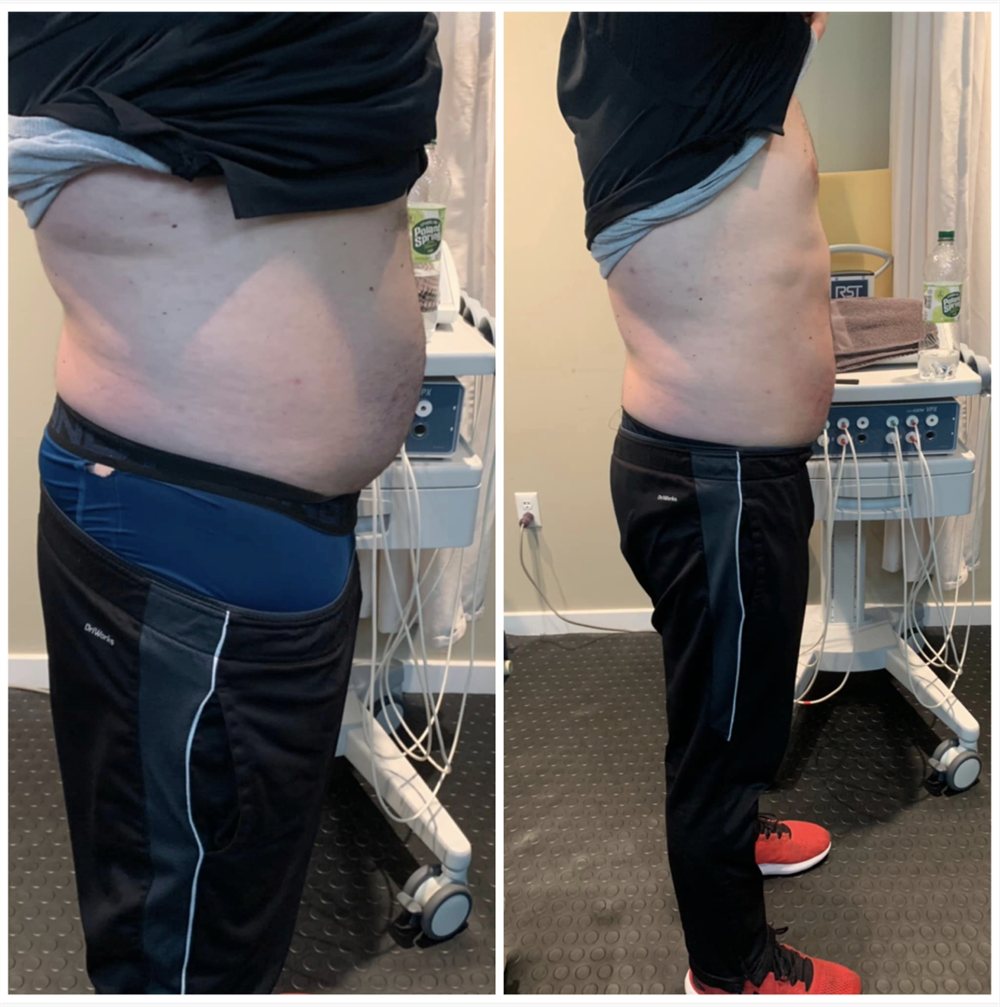 Lower stomach fat loss before and after