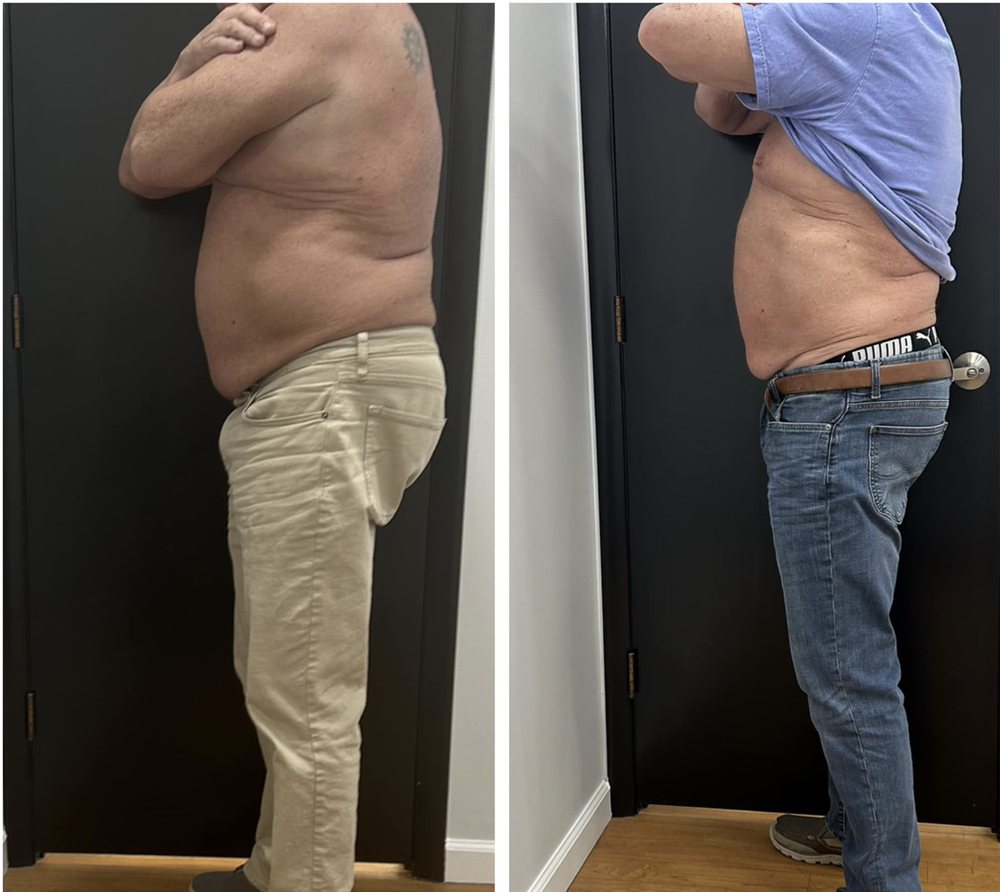 Waist and flank reduction before and after