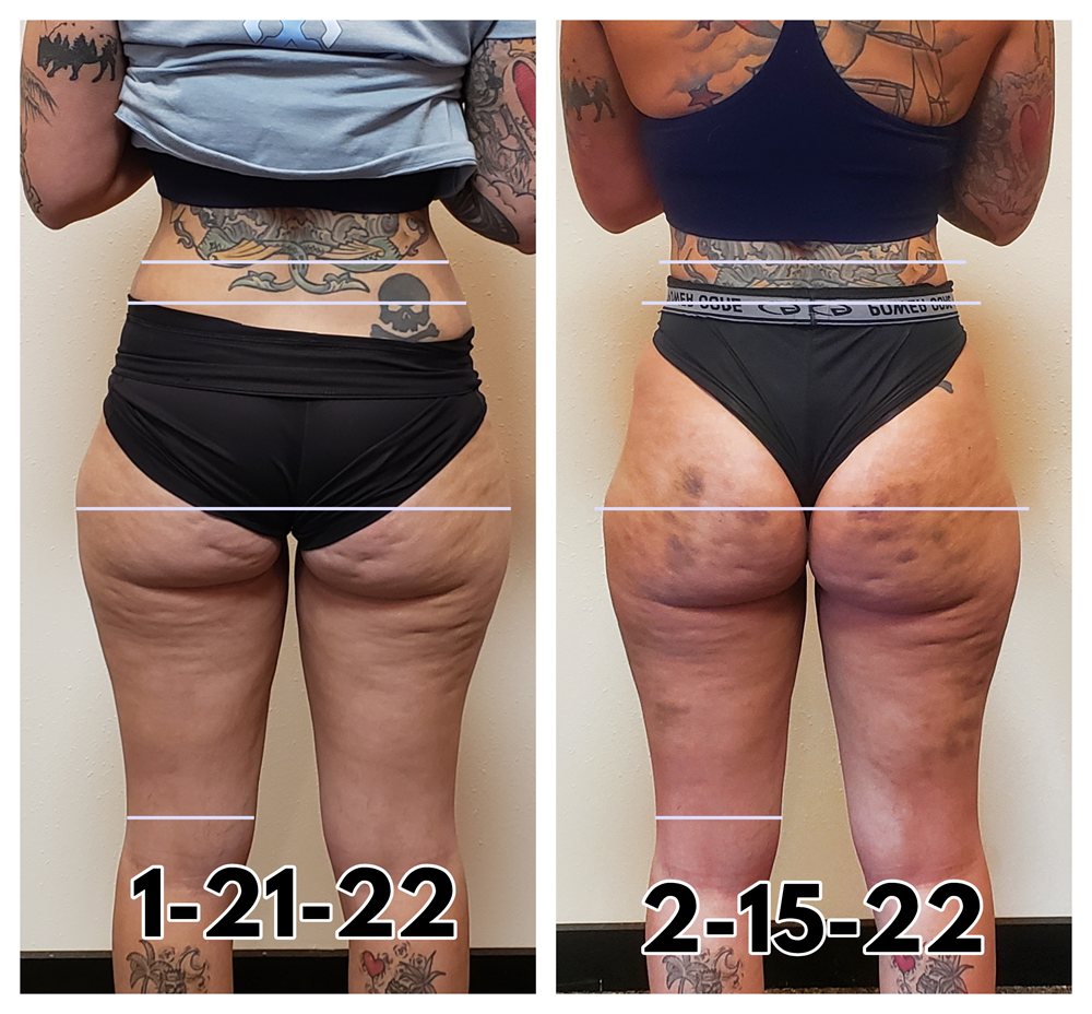 Thigh contouring before and after